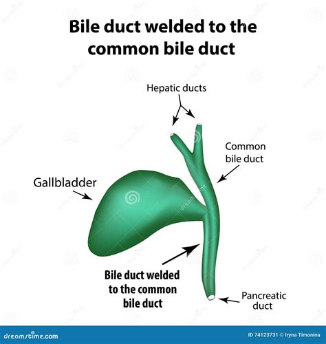 Bile Duct Welded To the Common Bile Duct. Pathology of the Gallbladder. Cholecystitis Stock ...