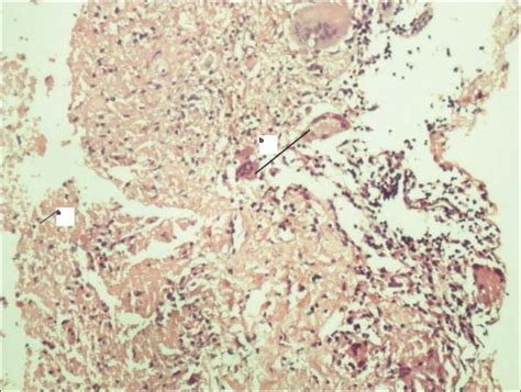 Photomicrograph showing caseation necrosis on the left (a) to the right ...