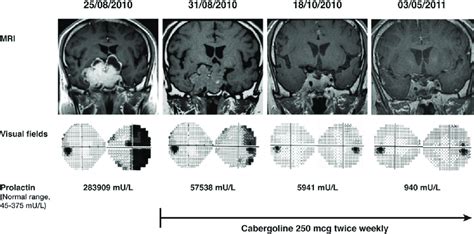 Cabergoline-induced shrinkage of a prolactinoma. Sequential MRIs, PRL ...