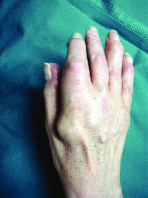 Clinical appearance of multiple tophaceous deposits on the right hand ...