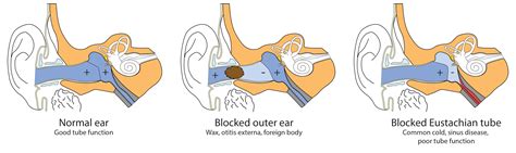 Inner ear barotrauma recovery time - locoglop