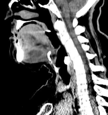 Ludwig angina | Radiology Case | Radiopaedia.org