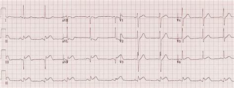 Inferior STEMI • LITFL • ECG Library Diagnosis