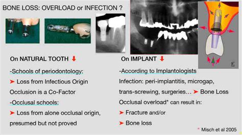 Can dental implants cause bone loss - Dental News Network