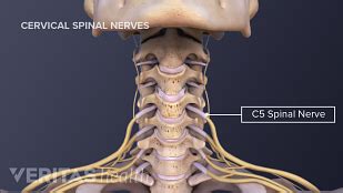 Cervical Radiculopathy from a Herniated Cervical Disc