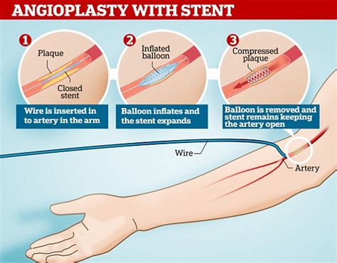 WHAT IS A STENT PLACEMENT? | Daily Mail Online