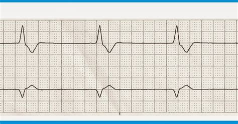 Ekg Practice Strips Printable