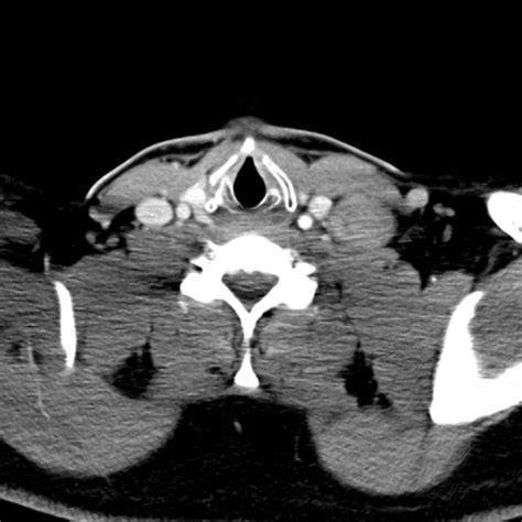 Differential Diagnosis of Cervical Lymphadenopathy