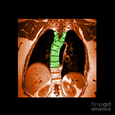 Mri Of Thoracic Scoliosis Photograph by Medical Body Scans