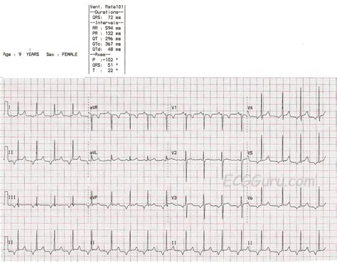 Atrial Rhythm