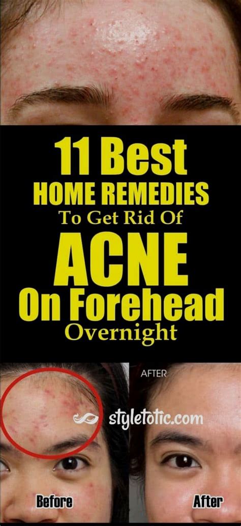 11 Best Acne Remedies To Get Rid Of Acne On Forehead Overnight | Best acne remedies, How to get ...