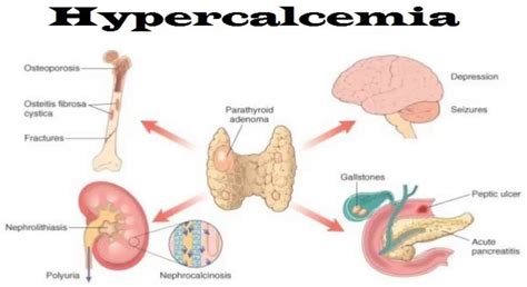 Hypercalcemia - Causes, Signs, Symptoms, Workup, Treatment