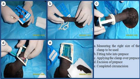 Figure 1 from The safety profile and acceptability of a disposable male circumcision device in ...