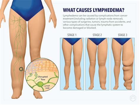 Causes Of Lymphedema Lower Leg