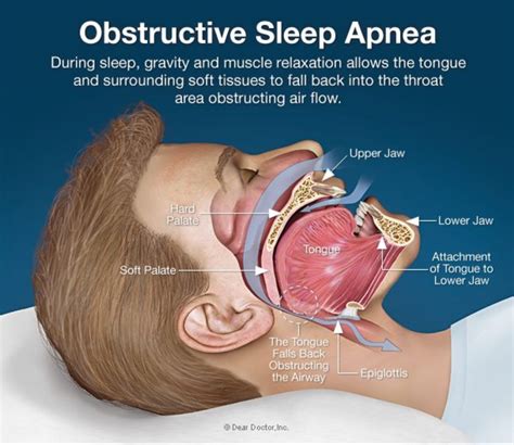 What is Sleep Apnea? - Dr. Ismail