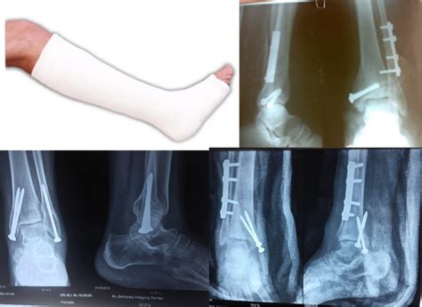 45 treatment of ankle fractures | Download Scientific Diagram