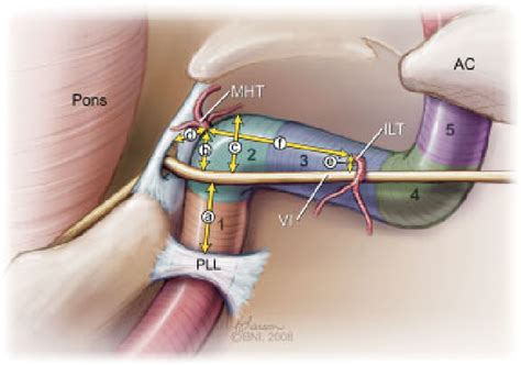 Illustration shows segments of intracavernous ICA: (1) posterior ...