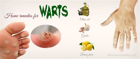 27 Proven Home Remedies For Warts On Hands & Feet