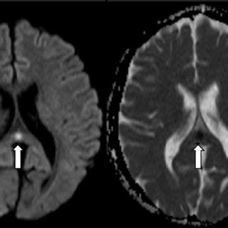 MRI diffusion-weighted image and the corresponding ADC showing focus of... | Download Scientific ...