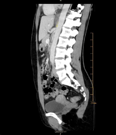 Cureus | Celiac Artery Compression Syndrome in a Middle-age Woman Treated Laparoscopically