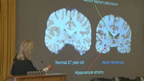 Ex-NFL player Aaron Hernandez suffered substantial brain damage from CTE, doctor says - ABC30 Fresno