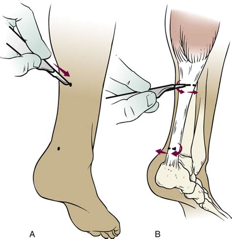 Top 97+ Pictures Pictures Of Achilles Tendon Surgery Completed