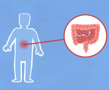 Intestinal Gas Causes Belching, Bloating, And Flatulence | Digestive ...