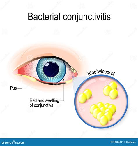 Bacterial Conjunctivitis