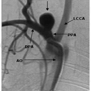 Two-dimensional, anteroposterior subclavian artery angiogram with ...