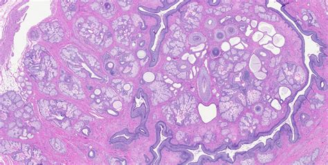 Teratoma Histology