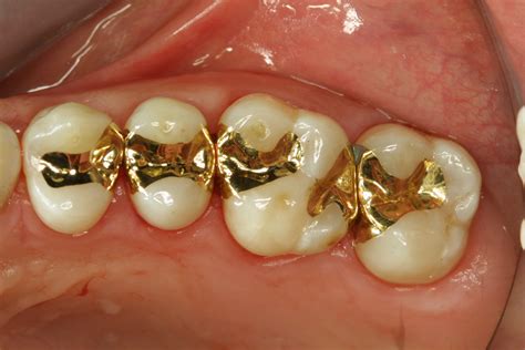 Updates in Dental Excellence: Gold Inlay Examples on My Happy Patients