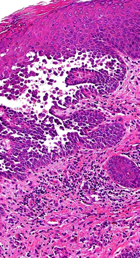 Pathology of Hailey-Hailey Disease | Histology slides, Pathology, Acid fast