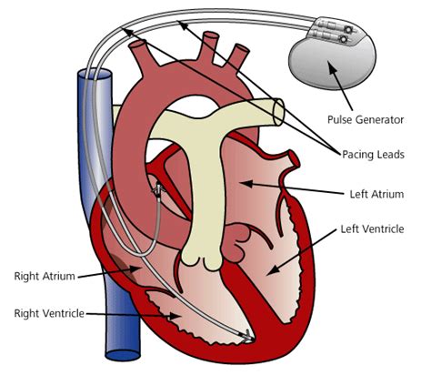 Doctors Gates: Cardiac Pacemaker