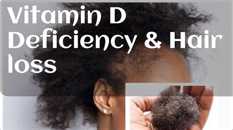 Vitamin D Deficiency Hair Loss - All You Need Infos