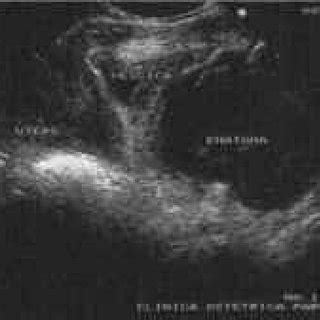 (PDF) Retzius' space haematoma after spontaneous delivery: A case report