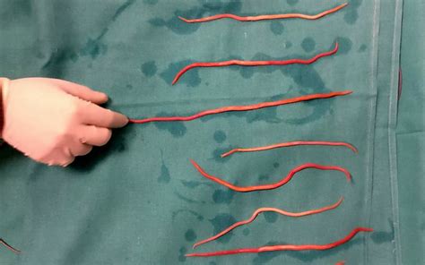 Doctors Pulled 14 Squirming Roundworms from a Woman's Bile Ducts | Live ...