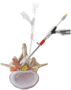 Endoscopic Decompression | Scottsdale, AZ Orthopedic Spine Surgery