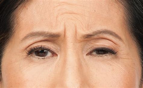 Botox Middletown, NJ | Red Bank Botox