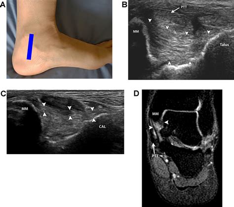 Normal and Injured Ankle Ligaments on Ultrasonography With Magnetic Resonance Imaging ...