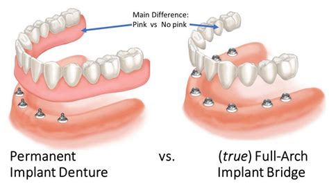 Fixed Bridges vs Fixed Dentures - The Complete Guide