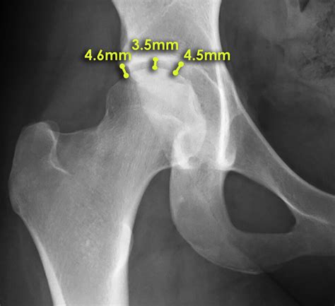 Osteoarthritis Hip X Ray Findings