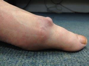 Big Toe Arthritis (Hallux Rigidus) | The London Foot & Ankle Clinic