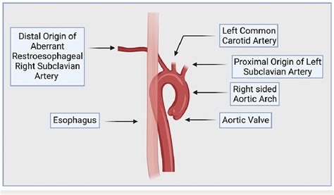 Illustration of the Distal Origin of the Aberrant Right Subclavian... | Download Scientific Diagram