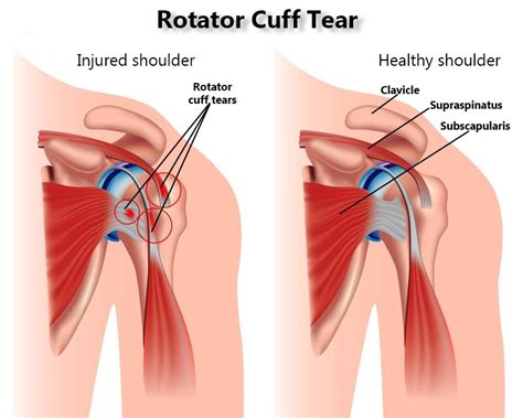 Rotator Cuff Tear Treatment Specialists in NYC | New York Pain Care