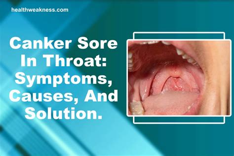 Canker Sore In Throat: Symptoms, Causes, And Solution (2024)