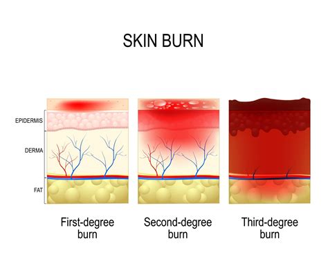 Four Critical Steps To Burn Treatment When Burns Occur