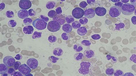 Leukocytosis: Types, Causes, Symptoms, Complications & Treatment