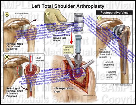 Left Shoulder Joint Replacement (Arthroplasty) - Medivisuals Inc.