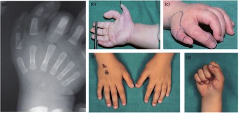 (a)-(c) Preoperative images of a patient with TPT and radial... | Download Scientific Diagram