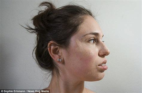 Agony of woman with rare condition that makes her damage her own skin ...